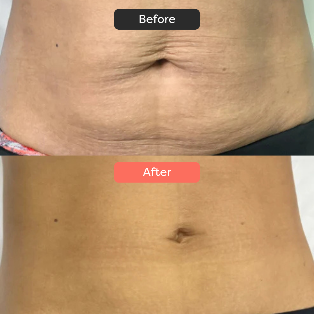 Thermoslim Body Sculpting Device