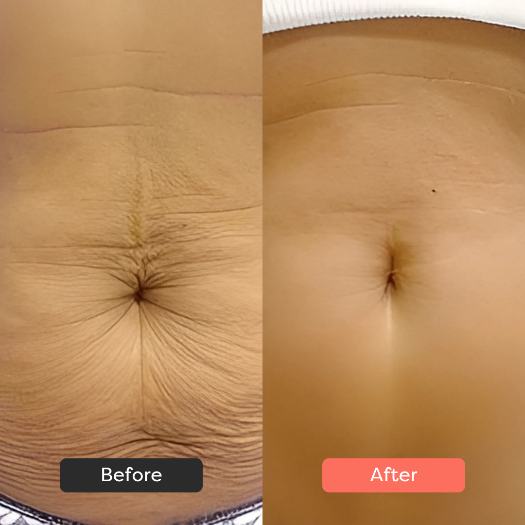 Thermoslim Body Sculpting Device
