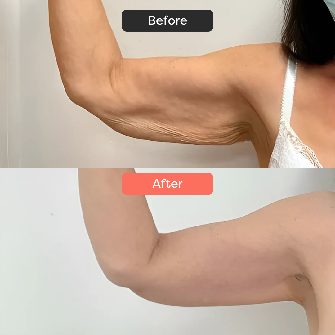Thermoslim Body Sculpting Device