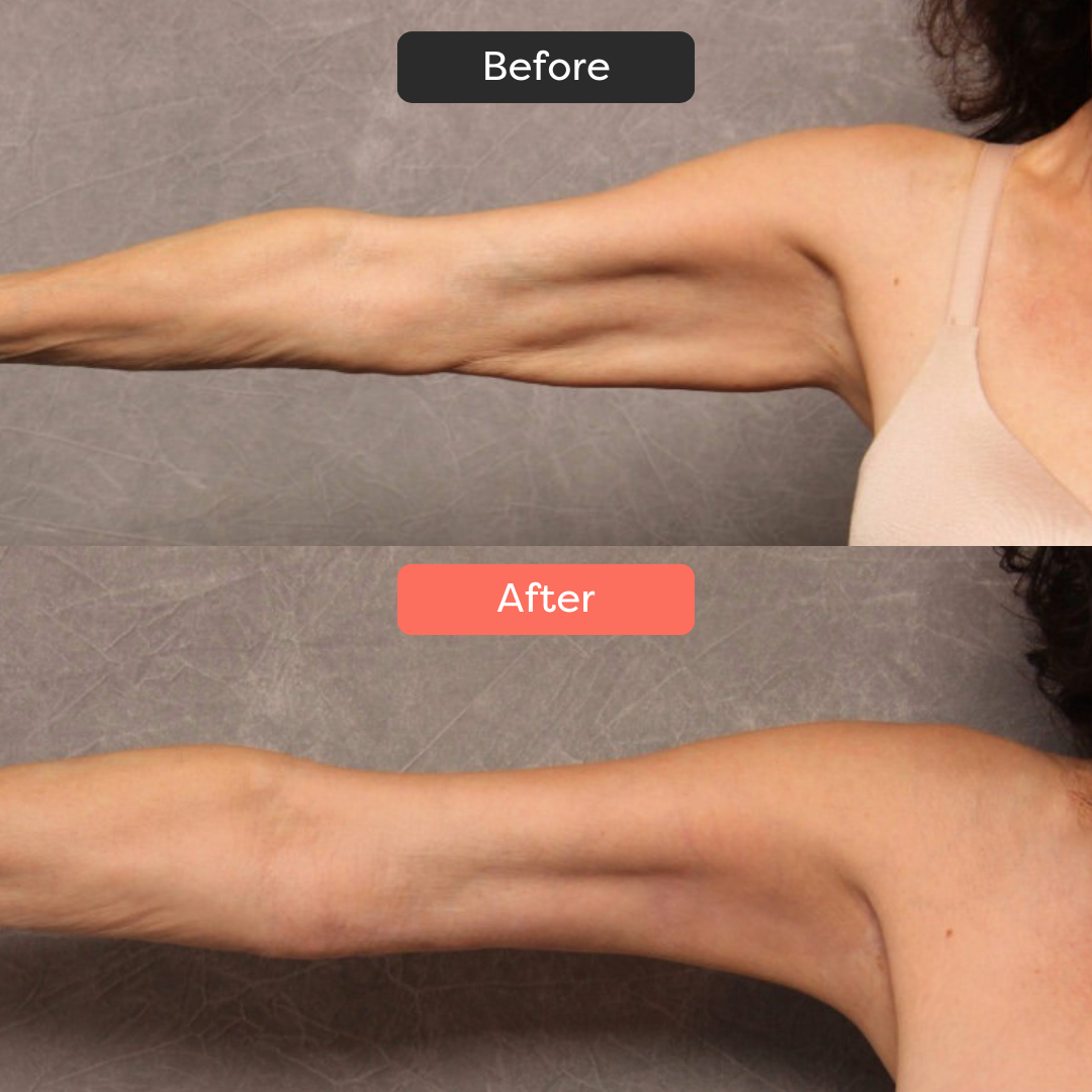 Thermoslim Body Sculpting Device