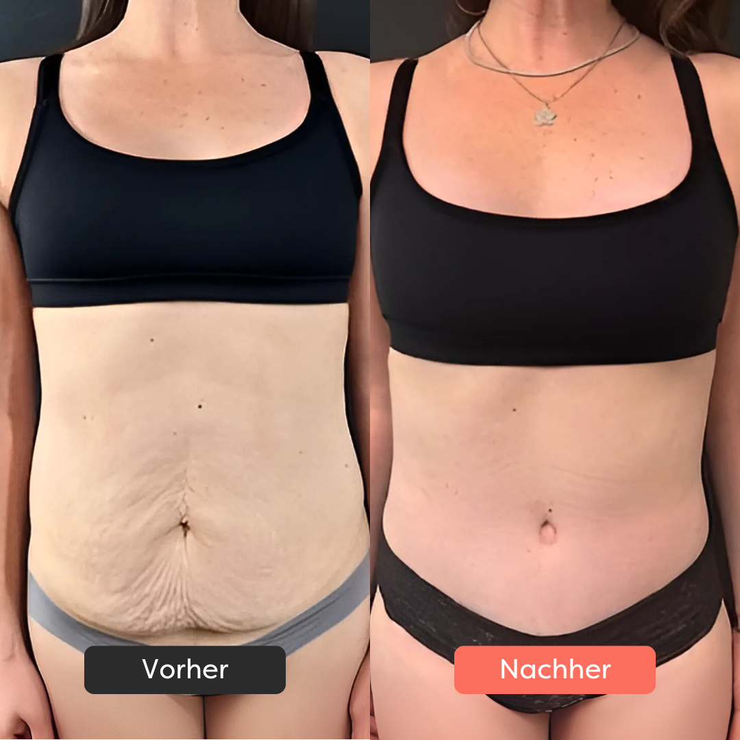 Thermoslim Body Sculpting Device