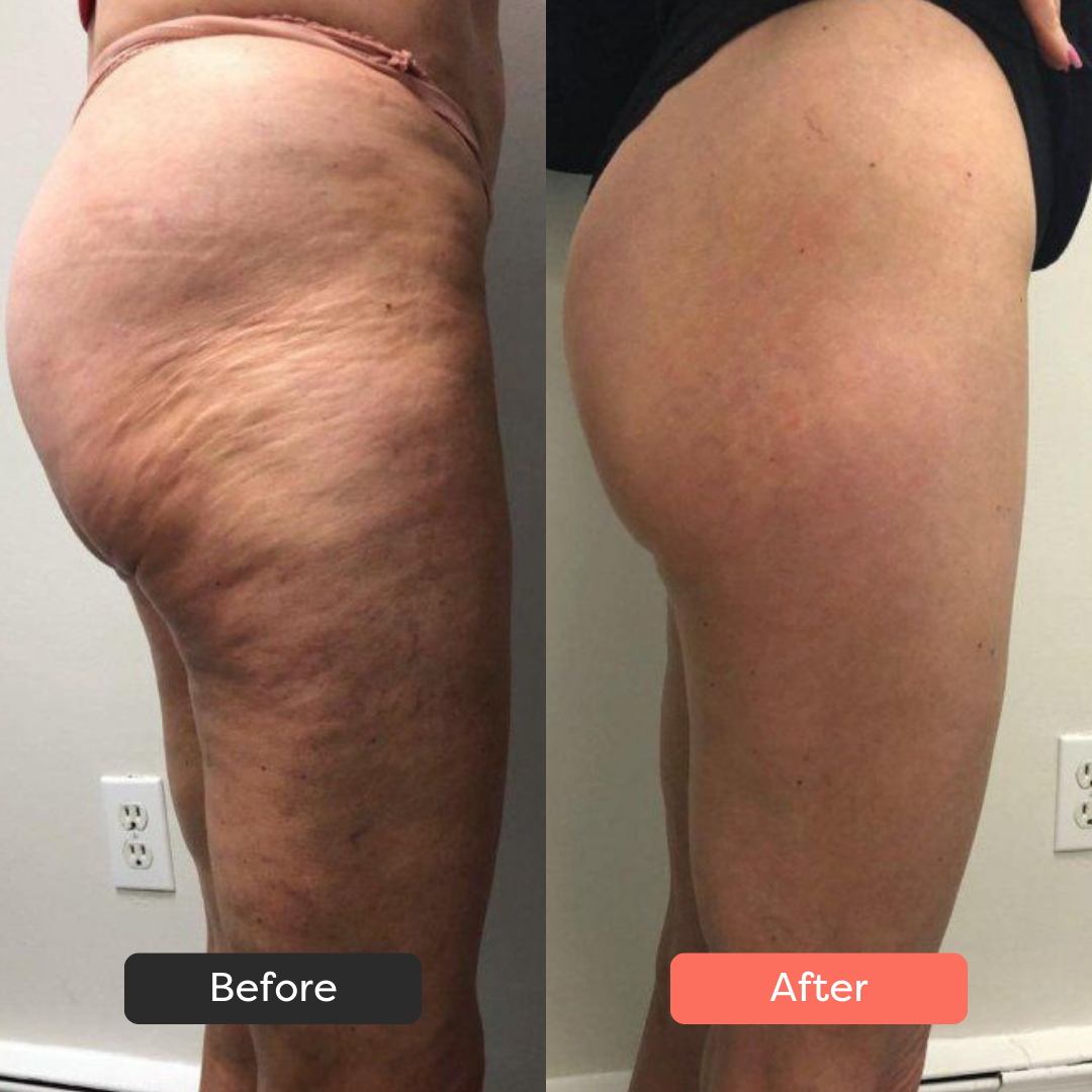 Thermoslim Body Sculpting Device