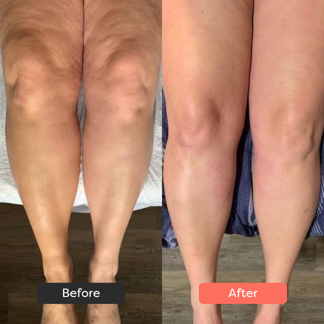 Thermoslim Body Sculpting Device