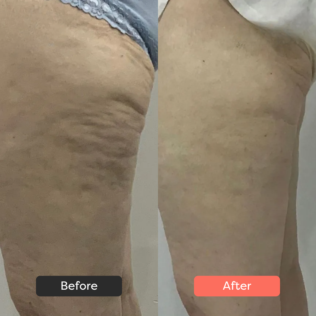 Thermoslim Body Sculpting Device