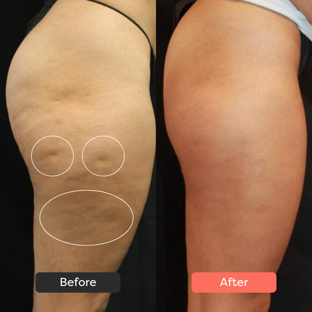 Thermoslim Body Sculpting Device