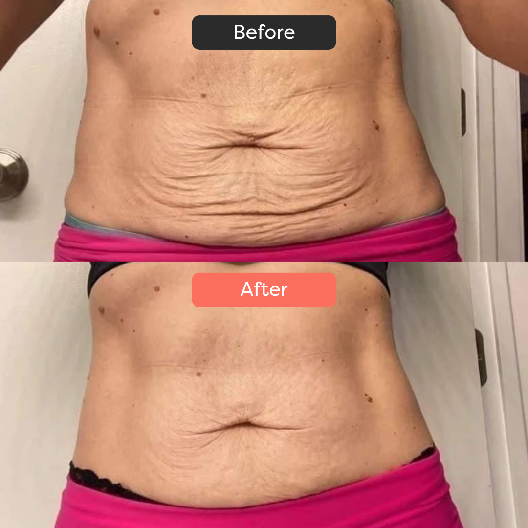 Thermoslim Body Sculpting Device