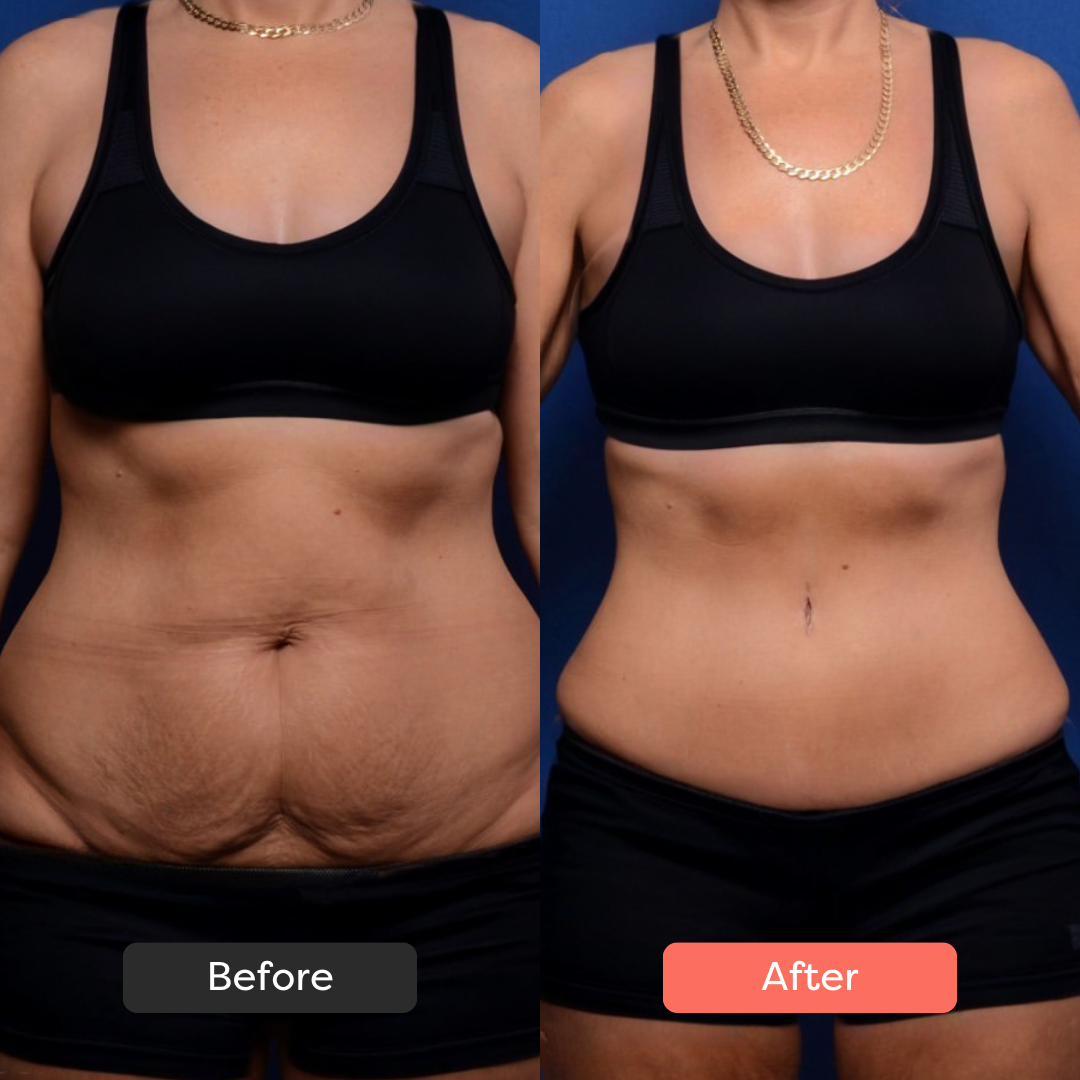 Thermoslim Body Sculpting Device